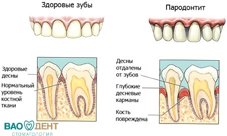лечение пародонтоза восстания санкт петербург стоматология вао дент 
