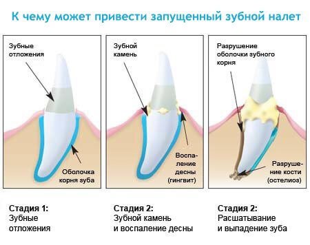 зубной налет как избавиться санкт петербург стоматология вао дент 