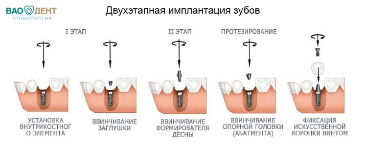 двухэьапная имплантация зубов в Санкт-Петербурге клиника ВАО Дент 